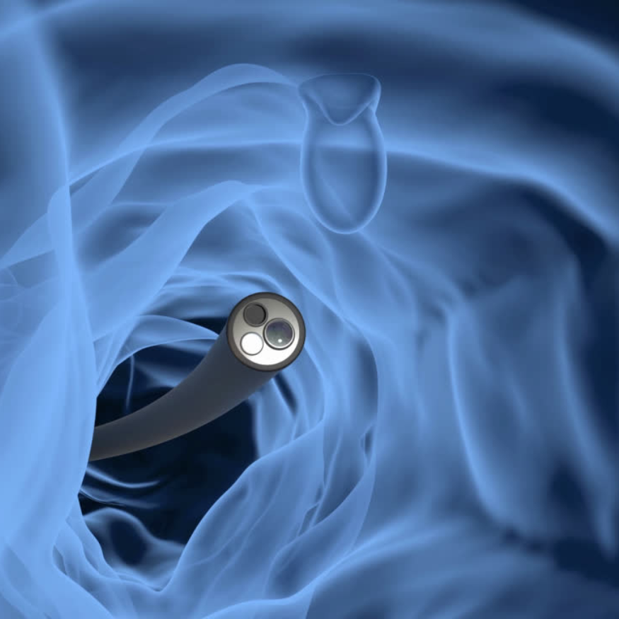 Colonoscopia - Cribado y diagnóstico